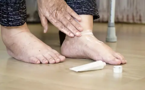 Osoba smaruje stopę kremem, łagodząc ból dużego palca w stopie, który może być związany z cukrzycą.