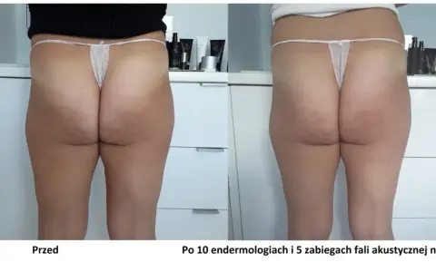 Widoczne efekty endermologii po 10 zabiegach i 5 fal akustycznych na uda. Skóra na pośladkach i udach jest gładsza, cellulit zredukowany.