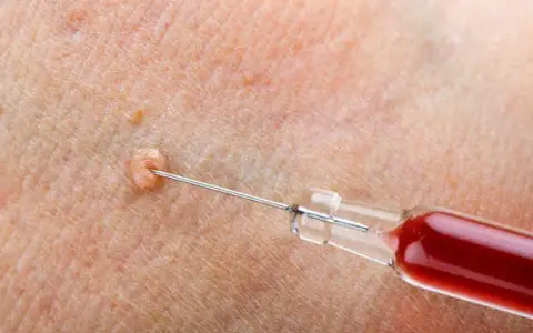 Kłykciny kończyste: dermatolog czy urolog? Wybierz właściwego lekarza!