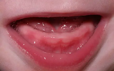 Dziąsła niemowlaka z widocznymi guzkami Bohn'a, które mogą być oznaką wyrzynania się ząbków.