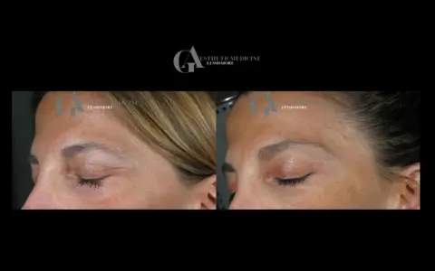 Confronto botox viso prima e dopo: rughe attenuate sulla fronte e contorno occhi più disteso.