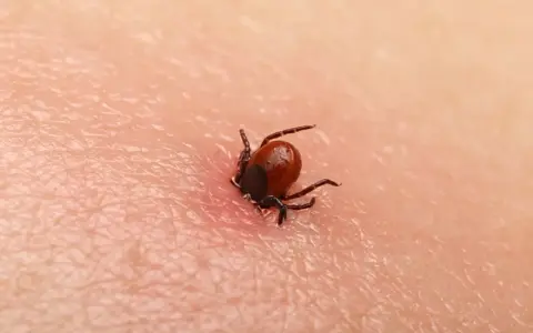 Jak bezpiecznie wyciągnąć kleszcza? Poradnik krok po kroku
