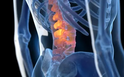 Anatomical rendering of a human spine with inflamed vertebrae, highlighted in orange and red.