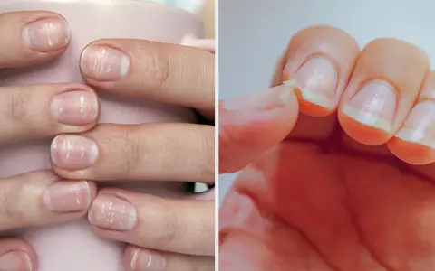 Ongles cassants, striés, manquent de nutriments essentiels. Une main montre des ongles fragiles, l'autre une écaille qui se détache.