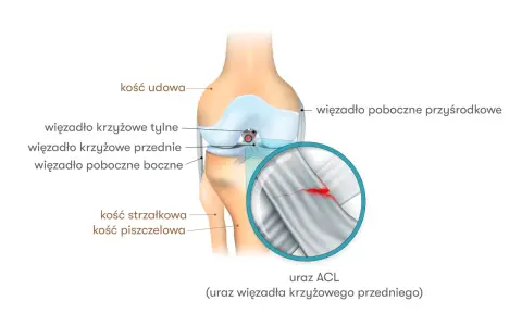 Anatomia kolana z zaznaczonym zerwanym więzadłem krzyżowym przednim (ACL). Leczenie zerwanego więzadła krzyżowego ile trwa?