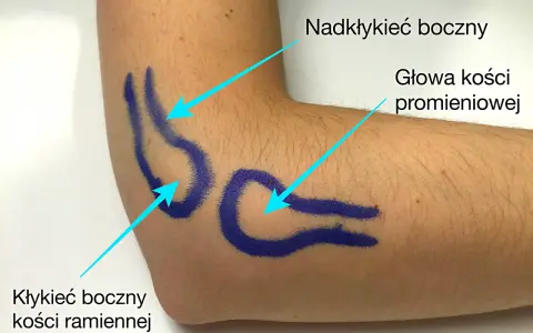 Zaznaczone na niebiesko struktury anatomiczne łokcia: nadkłykieć boczny kości ramiennej, głowa kości promieniowej i kłykieć boczny kości ramiennej.