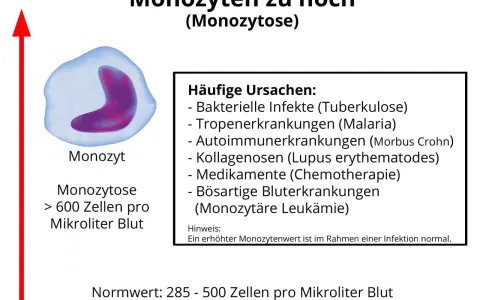 Erhöhte Monozyten (Monozytose) können auf Infektionen, Autoimmunerkrankungen oder Leukämie hinweisen. Der Normwert liegt bei 285-500 Zellen/µl.