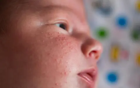 Skóra niemowlaka z zaczerwienieniem i wypryskami, objawy azs na szyi u niemowlaka.