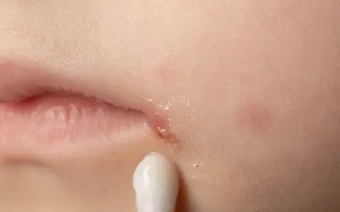 Zajady na ustach smarowane Tribiotic.