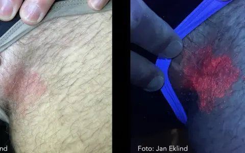 Hudförändring som kan vara leishmania hos människa. Till vänster syns en röd, fjällande fläck. Till höger, under UV-ljus, lyser fläcken starkt rött.