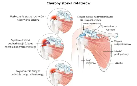 Ilustracja przedstawia budowę stawu barkowego i schorzenia mięśnia nadgrzebieniowego: naderwanie, zapalenie kaletki i zwyrodnienie ścięgna.