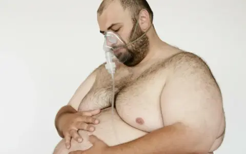 Mann mit Sauerstoffmaske, dessen stark übergewichtiger Körper auf eine ausatmung erschwert hindeutet.