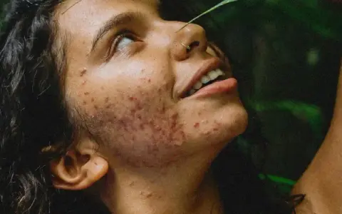Visage d'une jeune femme aux cheveux sombres, le regard levé, présentant une acné inflammatoire marquée sur la joue et le cou. Une feuille verte effleure son front.