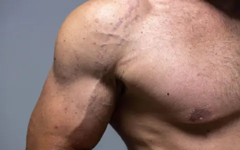 Widoczne rozstępy na bicepsie i ramieniu mężczyzny, świadectwo intensywnego treningu lub zmian wagi.