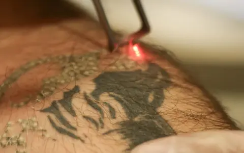 Laser usuwanie tatuażu. Czerwony promień lasera rozjaśnia ciemny wzór na skórze, rozpoczynając proces usuwania tatuażu.