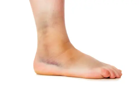 Caviglia gonfia e livida, segno di distorsione. Dopo quanto camminare si verifica?