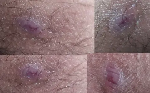Zmiany skórne w pachwinach, zaczerwienienie i podrażnienie. Zastanawiasz się, czym smarować odparzenia w pachwinach u dorosłych?