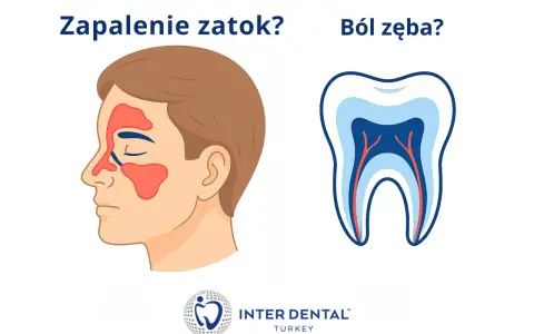 Ból podniebienia przy zębach górnych może być objawem zapalenia zatok lub problemów z zębami. Ilustracja porównuje zatoki i przekrój zęba.