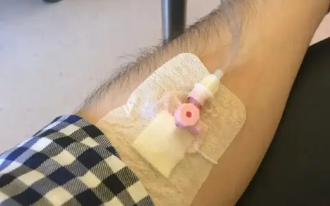 Ramię z wenflonem i plastrem, przygotowane do podania leku.