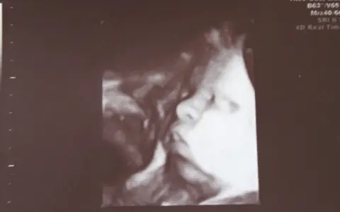 USG 3D pokazuje twarz dziecka w 32 tygodniu ciąży, który to miesiąc. Widać nos i usta.