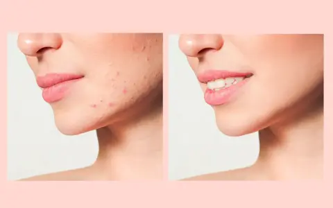 Prima e dopo: pelle con imperfezioni e poi pelle liscia e luminosa, mostrando la trasformazione dopo il processo di skin purging.