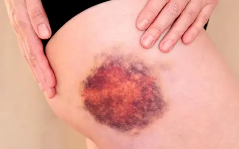 Große, dunkle blaue Flecken auf der Haut des Oberschenkels, die von einer Hand berührt werden.