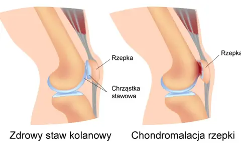Porównanie zdrowego stawu kolanowego z chondromalacją rzepki, gdzie chrząstka stawowa jest uszkodzona.