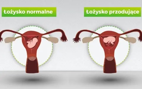 Porównanie: łożysko normalne vs. łożysko przodujące. Na pierwszym obrazku łożysko znajduje się na tylnej ścianie macicy, a na drugim – łożysko na przedniej ścianie.
