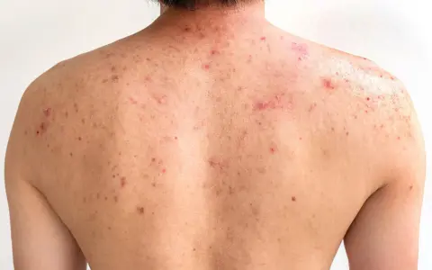 Espalda con acné, mostrando cómo quitar los granos de la espalda.