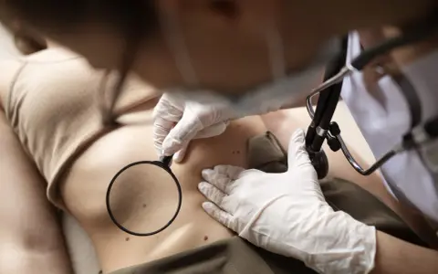 Lekarz w rękawiczkach bada pieprzyki na brzuchu pacjentki za pomocą lupy, przygotowując się do laserowego usuwania pieprzyków.
