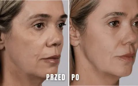 Przed i po zabiegu z użyciem kwasu polimlekowego. Skóra twarzy wygładzona, zmarszczki zredukowane, a owal twarzy poprawiony.