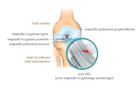 Anatomia kolana z zaznaczonym urazem ACL (przedniego więzadła krzyżowego). Widoczny pęknięty włókna więzadła.