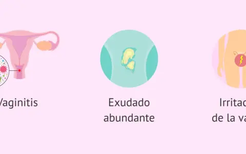 Ilustración de vaginitis, exudado y picazón vaginal, síntomas comunes de tricomoniasis.