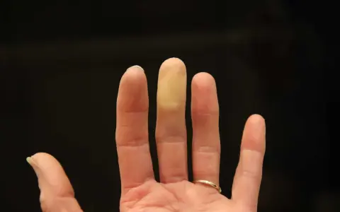 En hand med en gulnad fingertopp, som om den fryser. Kan vara ett tecken på kaloriunderskott.