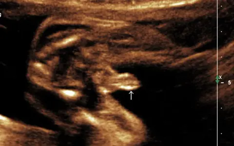 Ultraschallbild eines Babys in der 20. SSW. Der Pfeil zeigt auf die Genitalien, die auf XY-Chromosomen hindeuten.