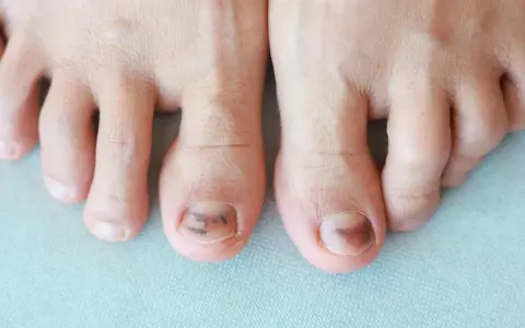 Dita dei piedi con unghie maculate marroni, forse a causa di un trauma o un fungo.
