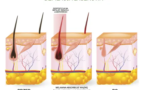 Ilustracja pokazuje laserowe usuwanie wąsika: przed zabiegiem, ekspozycję na laser i efekt po.