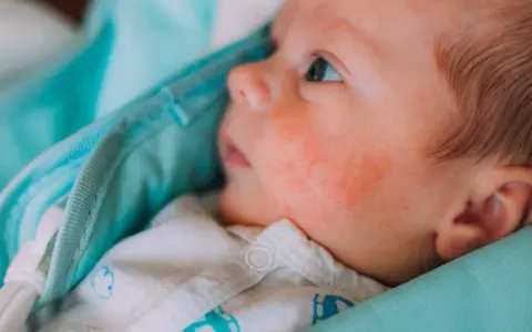 Jak rozpoznać potówki u niemowlaka i uniknąć niepotrzebnych problemów
