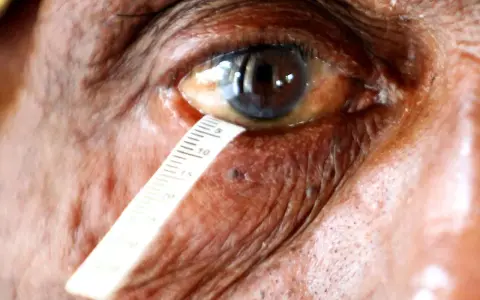 Misurazione della lacrimazione per un test occhio secco. La scala indica la quantità di liquido lacrimale.