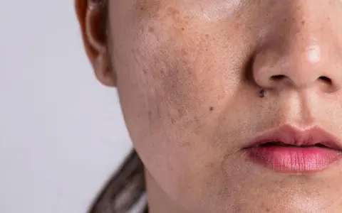 Primer plano de una cara con melasma y un pequeño lunar sobre el labio superior, simulando un bigote.