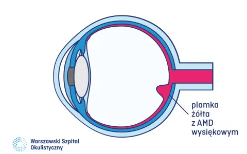 Schemat oka z zaznaczoną plamką żółtą z AMD wysiękowym.