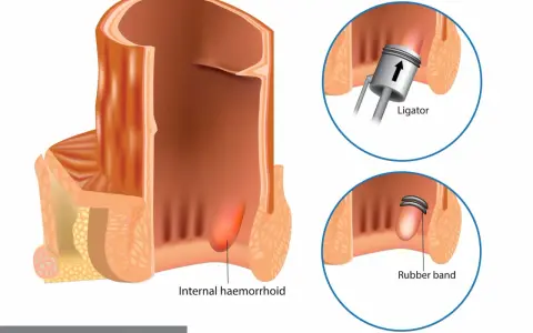 Illustration visar hur man kan ta bort hemorrojder med en gummibandsligering. Ett instrument placerar ett band runt hemorrojden.