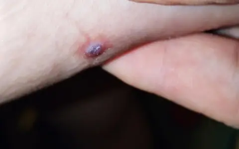 Una piccola piaga da decubito che sanguina, con un'area violacea al centro, su pelle chiara.