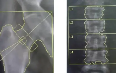 Badanie na osteoporozę: RTG biodra i kręgosłupa lędźwiowego z zaznaczonymi obszarami do analizy.