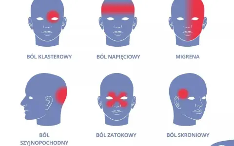 Ilustracja pokazuje różne rodzaje bólu głowy: klasterowy, napięciowy, migrenę, szyjnopochodny, zatokowy i skroniowy.