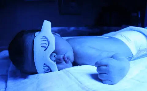 Neonato sotto lampada blu per curare l'ittero, con mascherina protettiva sugli occhi.