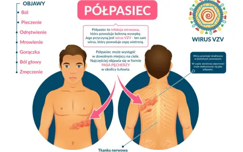 Półpasiec to wirusowa choroba objawiająca się bolesną wysypką. Czy półpasiec jest zaraźliwy? Tak, wirus VZV może się rozprzestrzeniać.