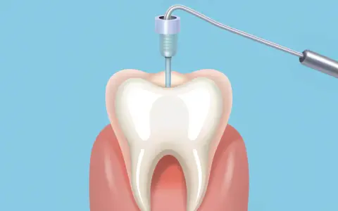 Ilustracja zęba z narzędziem dentystycznym w środku.