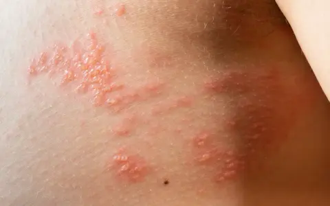 Eruzione cutanea con vescicole rosse e pruriginose, sintomo di un'allergia da istamina.