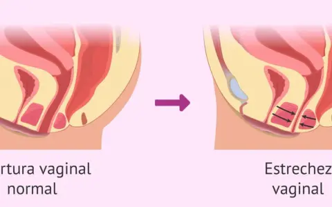 Ilustración comparativa de la abertura vaginal normal y la estrechez vaginal, donde se aprecian espasmos musculares en la segunda.